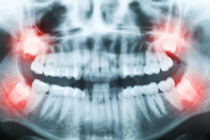 Digital X-ray technology at Sai Arogyam Dental Clinic Lohegaon Pune